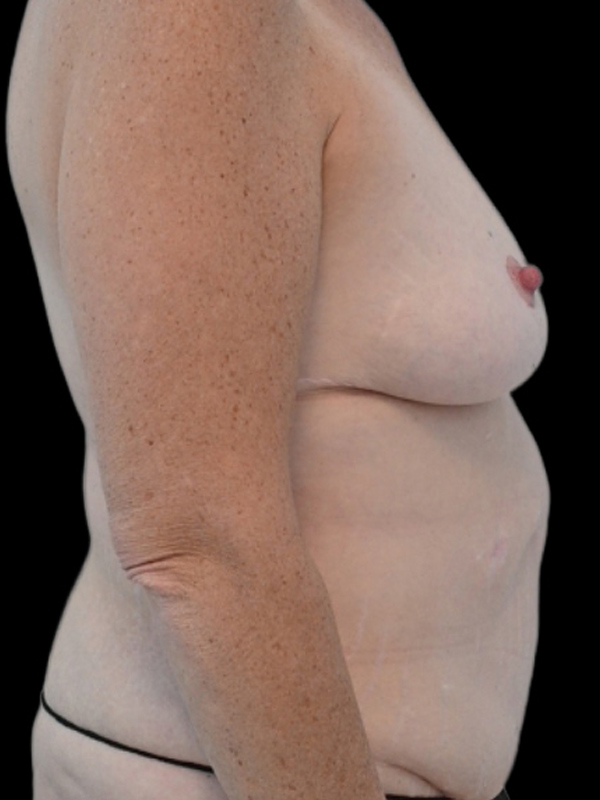 DIEP Flap Surgery Before & After Image