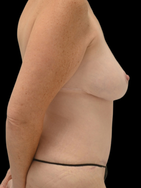 DIEP Flap Surgery Before & After Image