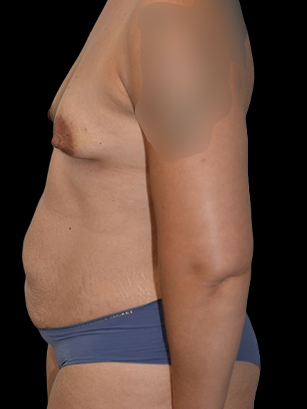 DIEP Flap Surgery Before & After Image