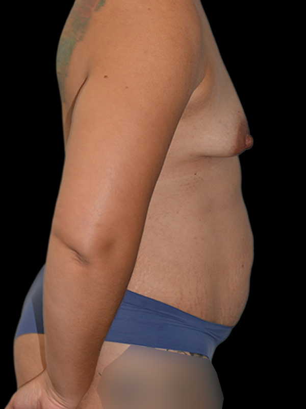 DIEP Flap Surgery Before & After Image