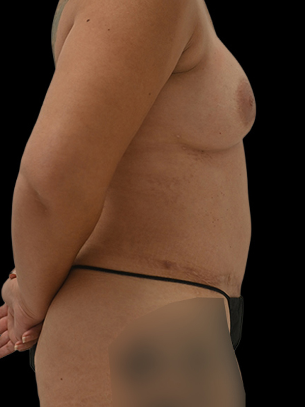 DIEP Flap Surgery Before & After Image