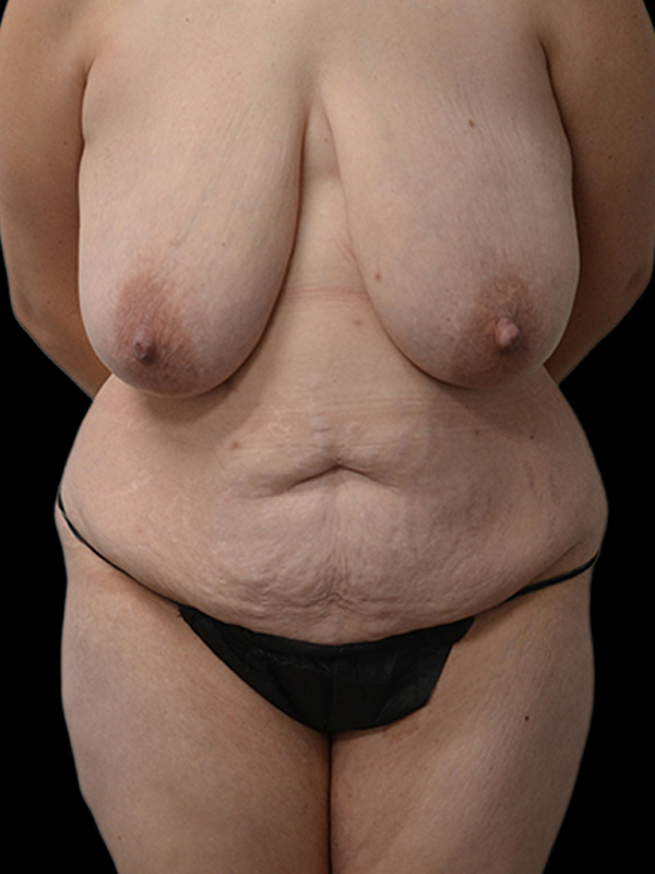 DIEP Flap Surgery Before & After Image