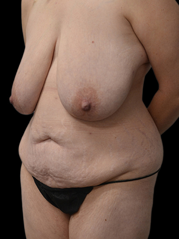 DIEP Flap Surgery Before & After Image