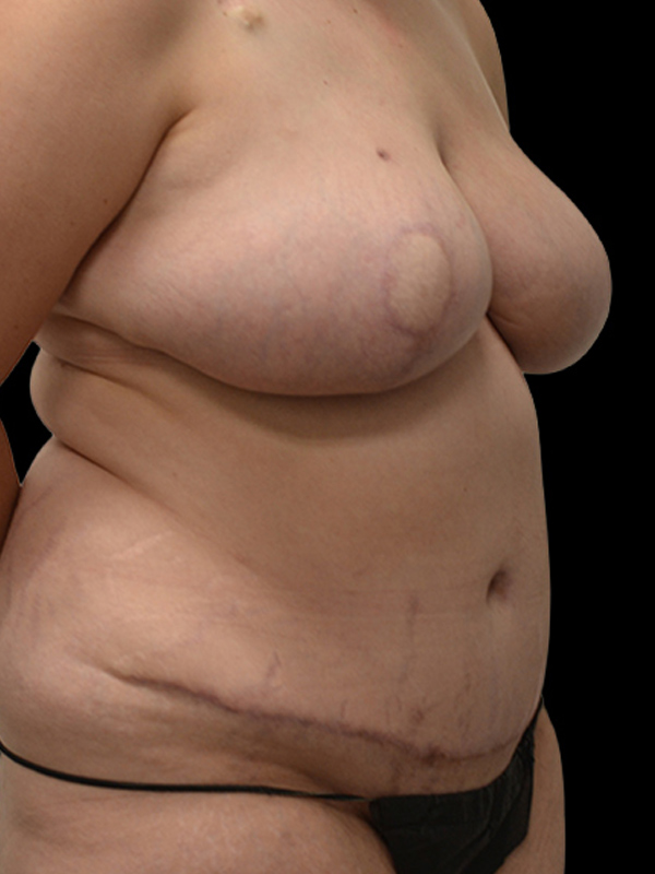 DIEP Flap Surgery Before & After Image