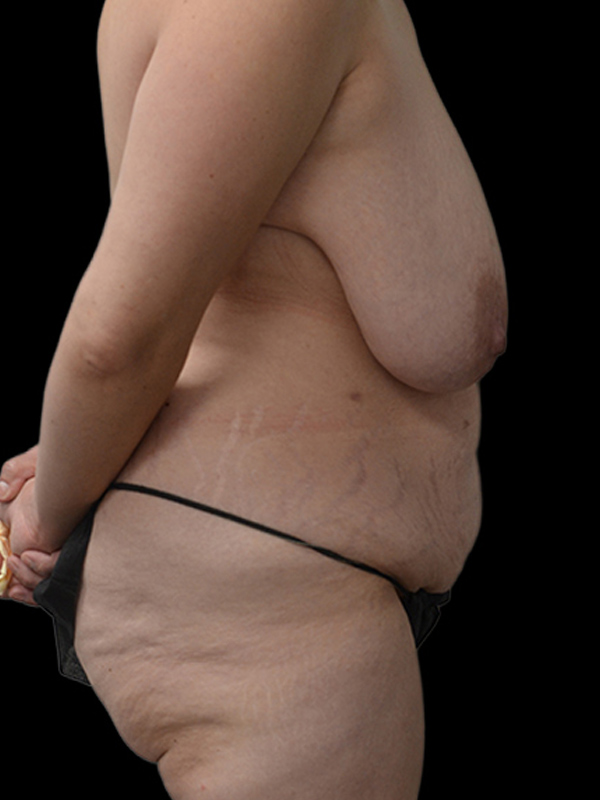 DIEP Flap Surgery Before & After Image