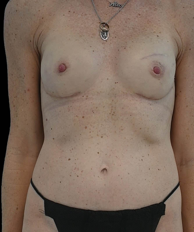 Direct-To-Implant Before & After Image