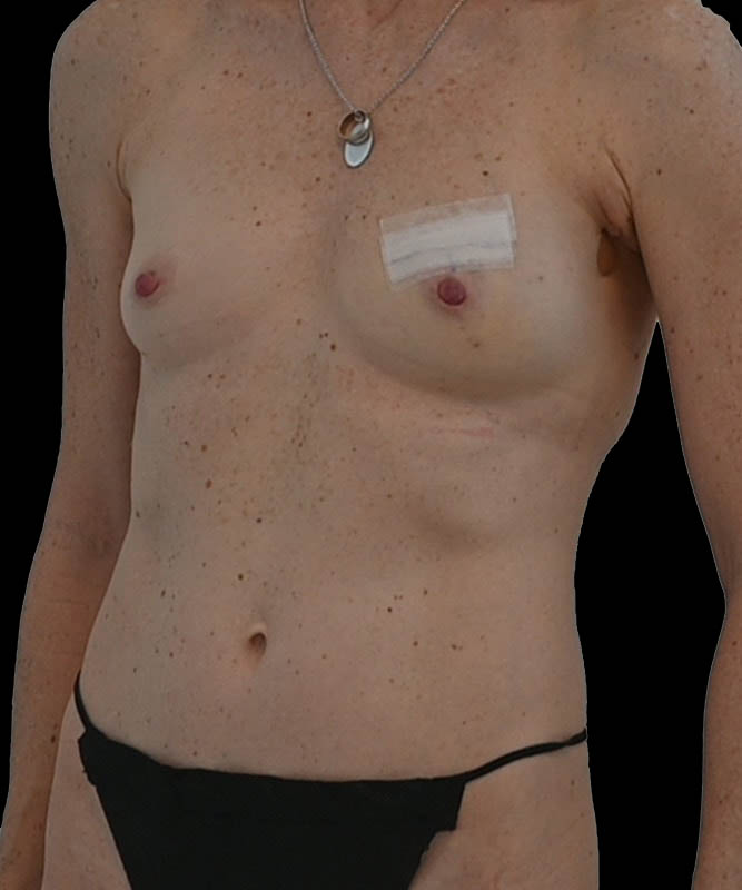 Direct-To-Implant Before & After Image