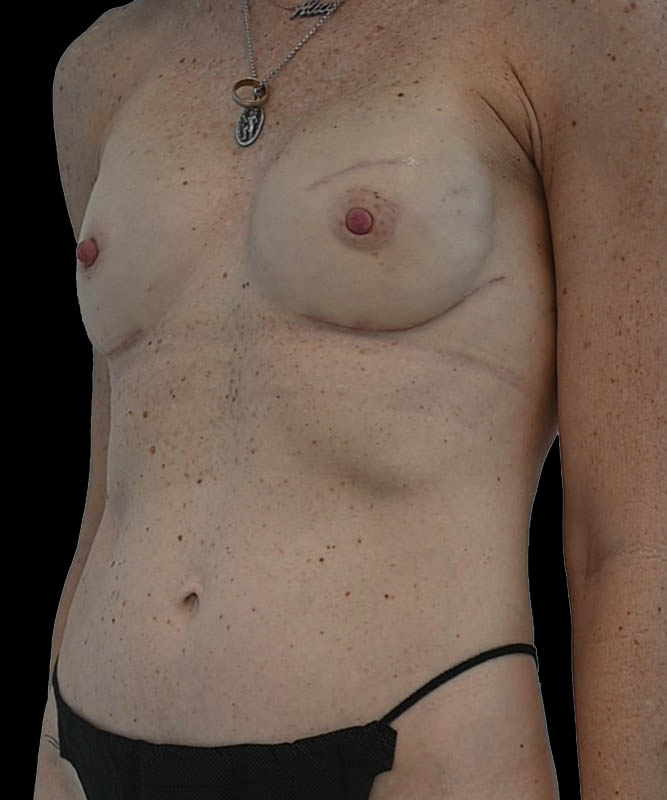 Direct-To-Implant Before & After Image