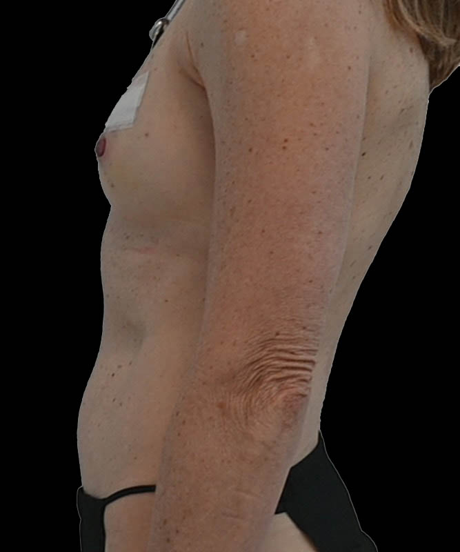 Direct-To-Implant Before & After Image