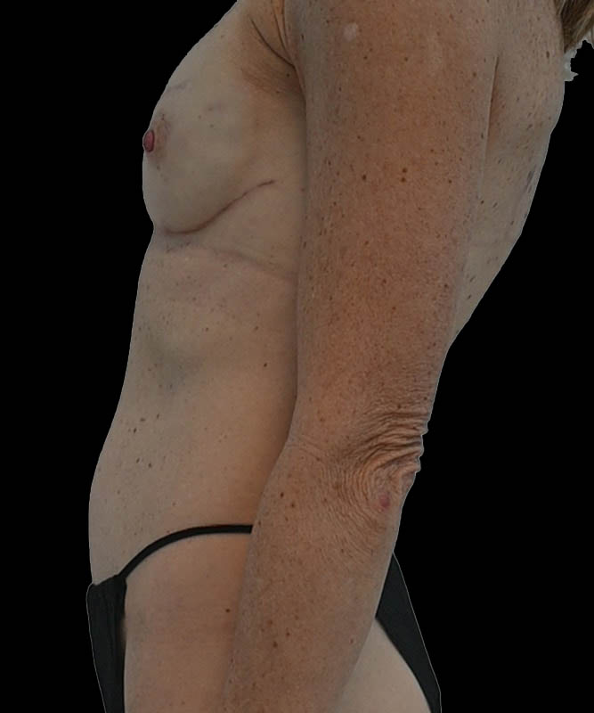 Direct-To-Implant Before & After Image