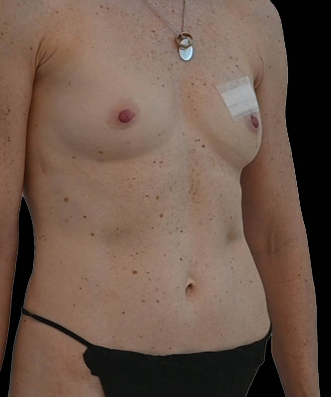 Direct-To-Implant Before & After Image