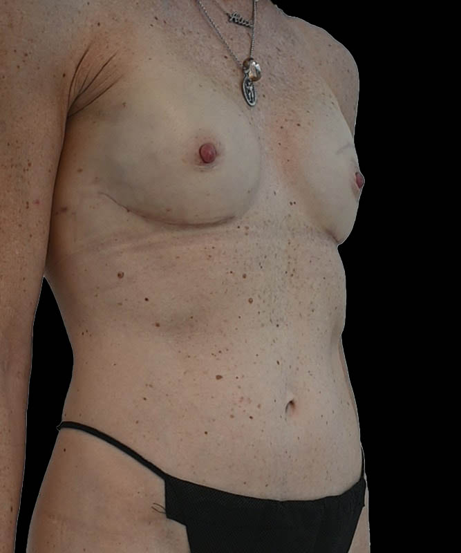 Direct-To-Implant Before & After Image