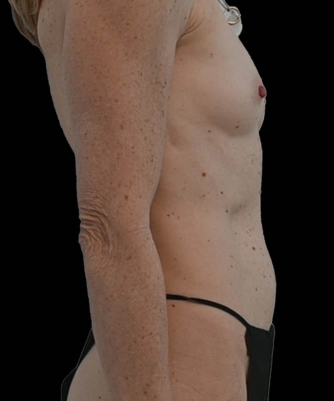Direct-To-Implant Before & After Image