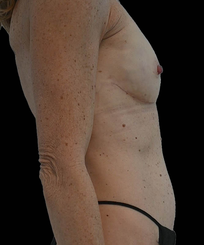 Direct-To-Implant Before & After Image