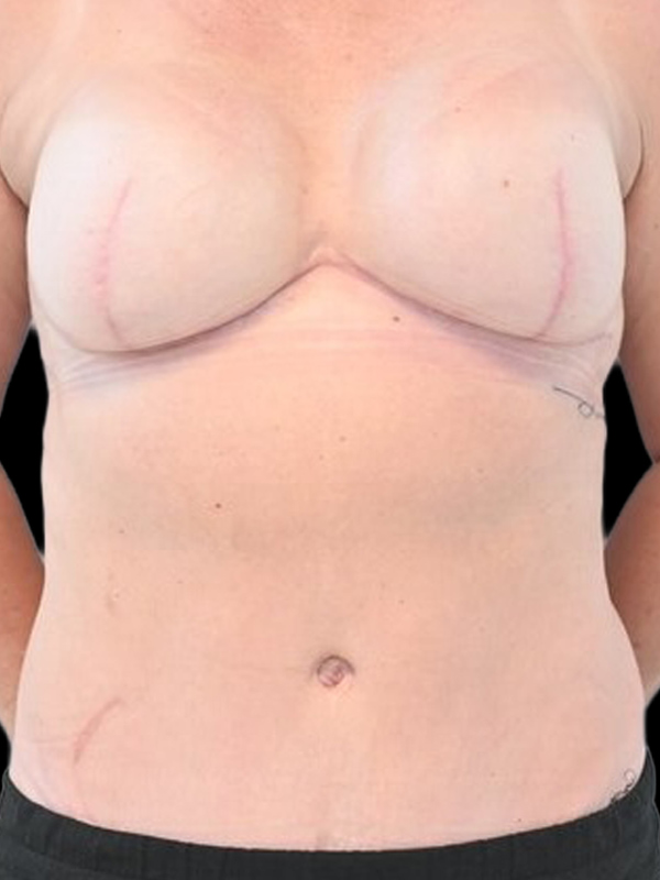 Direct-To-Implant Before & After Image