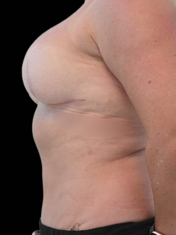 Direct-To-Implant Before & After Image
