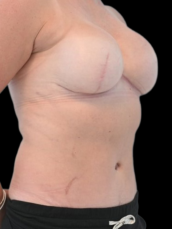Direct-To-Implant Before & After Image
