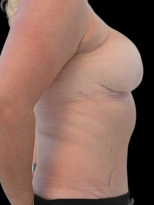 Direct-To-Implant Before & After Image