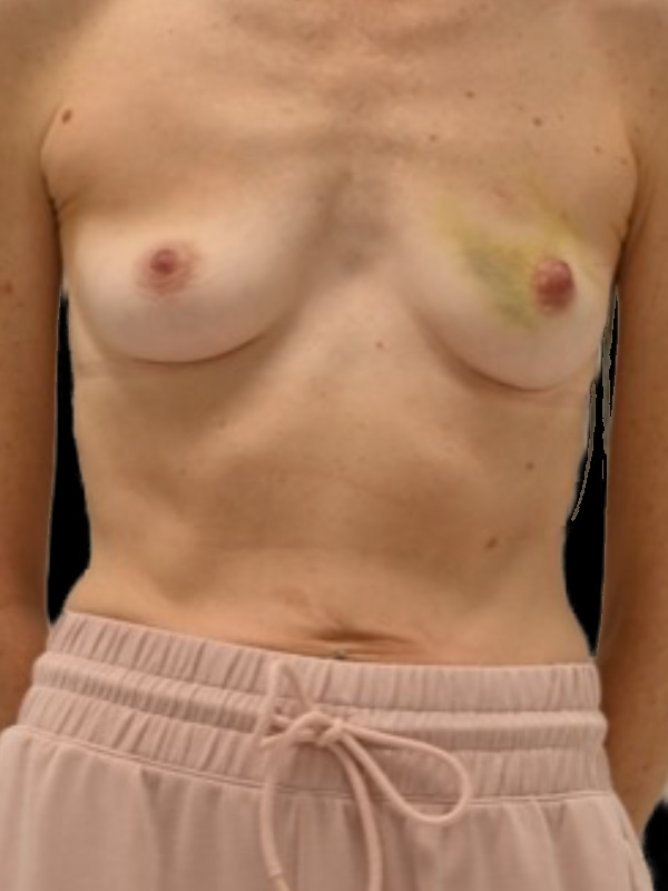 Direct-To-Implant Before & After Image
