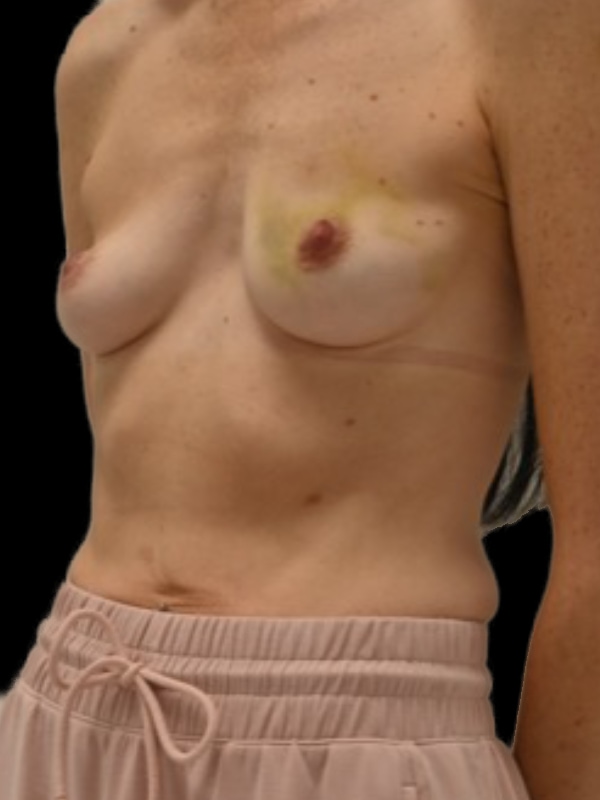 Direct-To-Implant Before & After Image