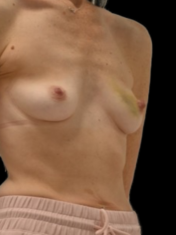 Direct-To-Implant Before & After Image