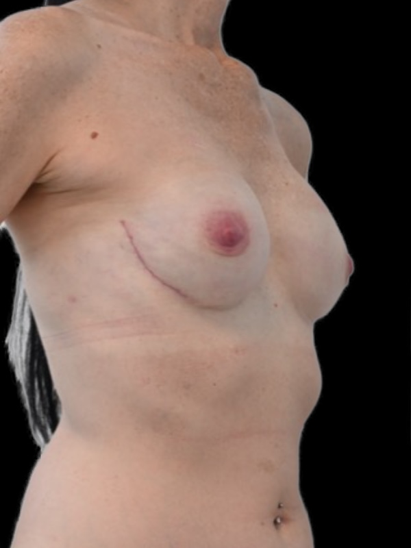 Direct-To-Implant Before & After Image