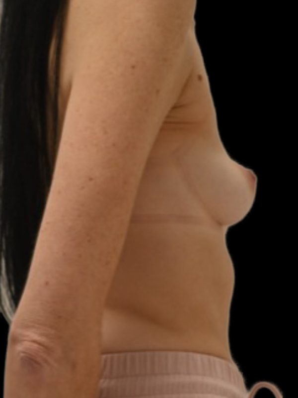 Direct-To-Implant Before & After Image