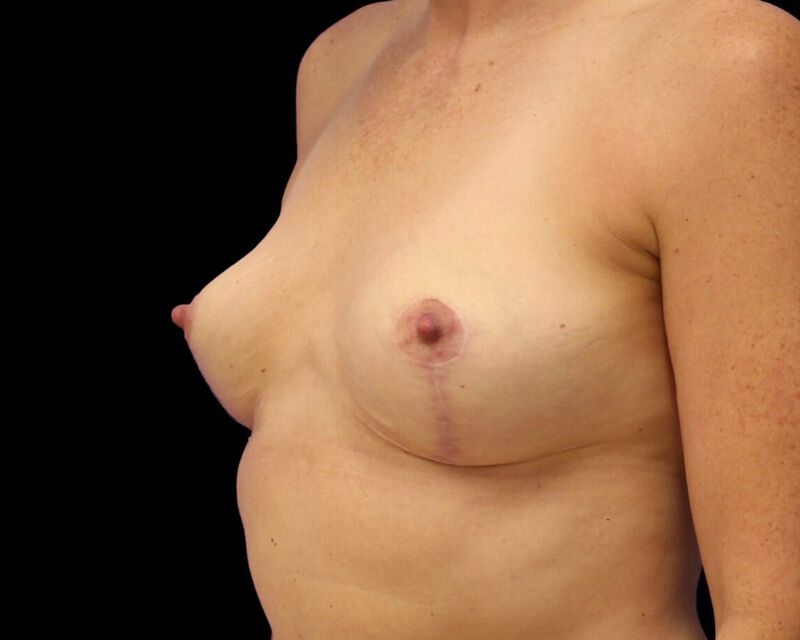 Explant with Mastopexy Before & After Image