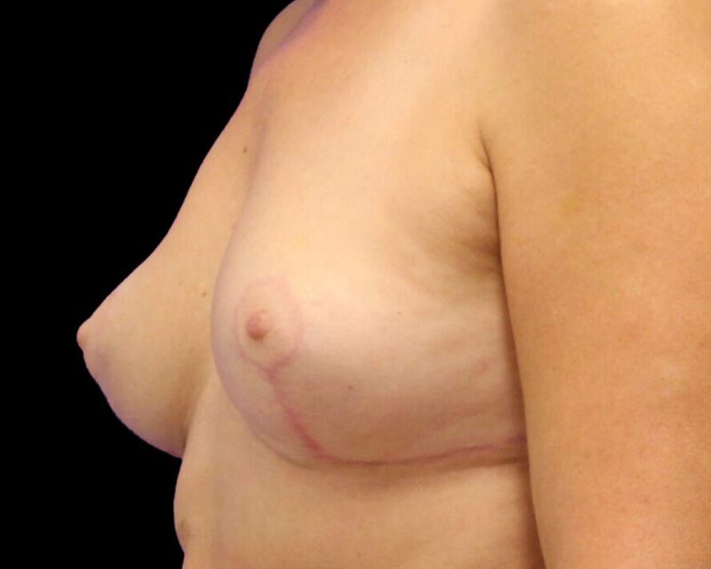 Explant with Mastopexy Before & After Image