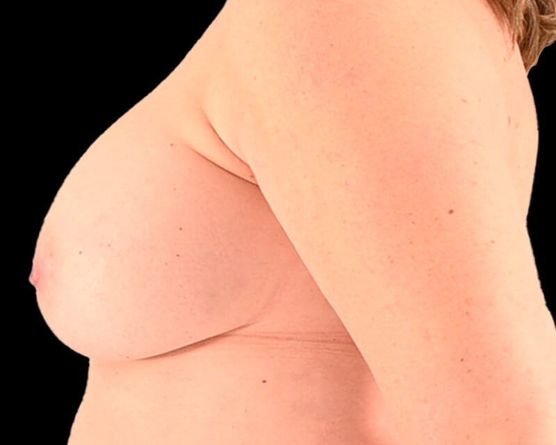 Explant with Mastopexy Before & After Image