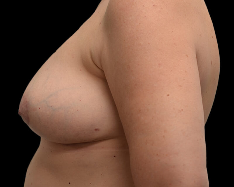 Explant with Mastopexy Before & After Image