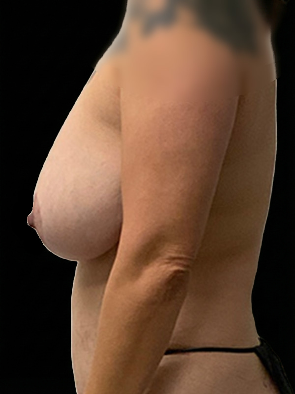 Explant with Mastopexy Before & After Image