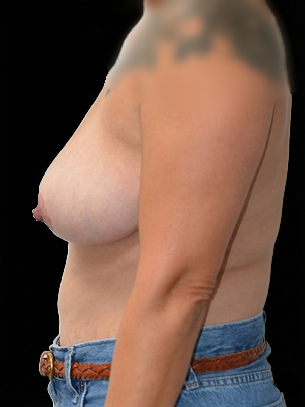 Explant with Mastopexy Before & After Image
