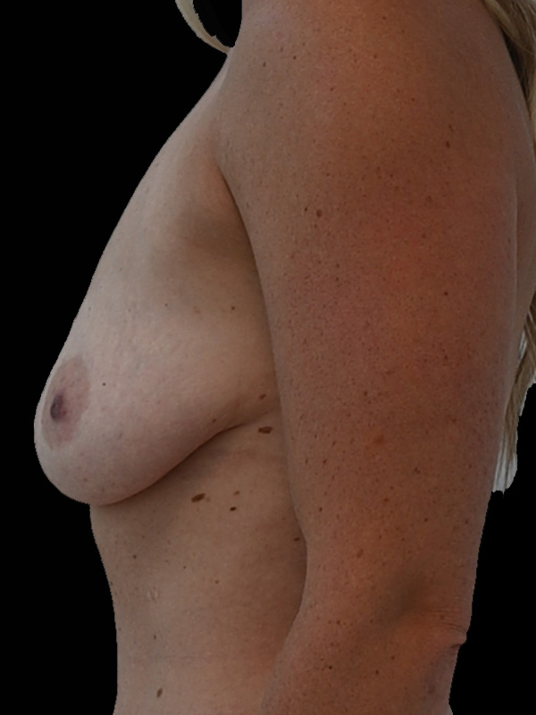 Hybrid Reconstruction Before & After Image