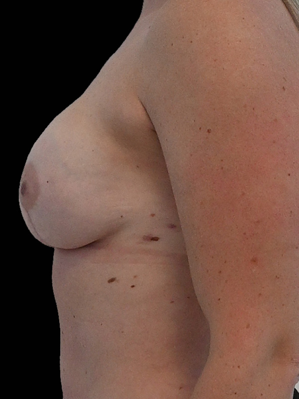 Hybrid Reconstruction Before & After Image