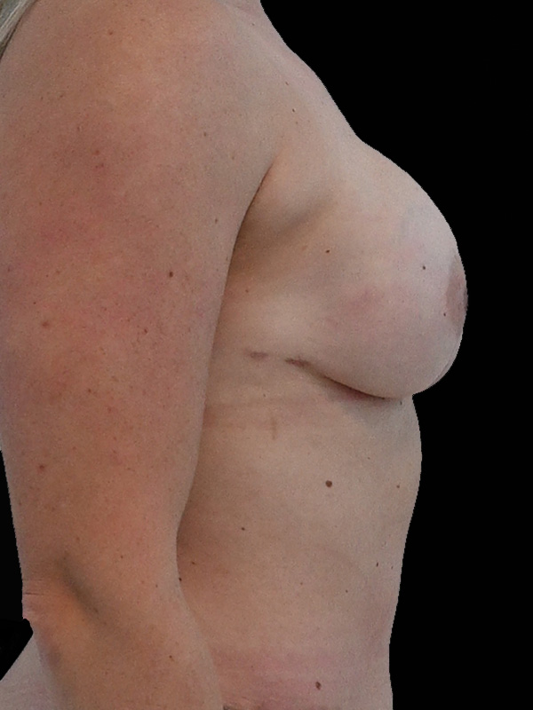 Hybrid Reconstruction Before & After Image