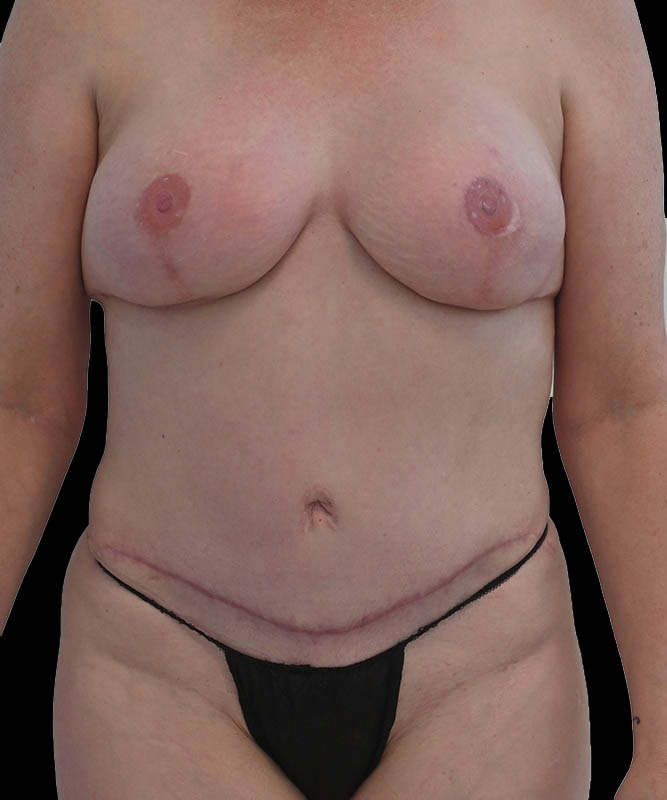 Hybrid Reconstruction Before & After Image