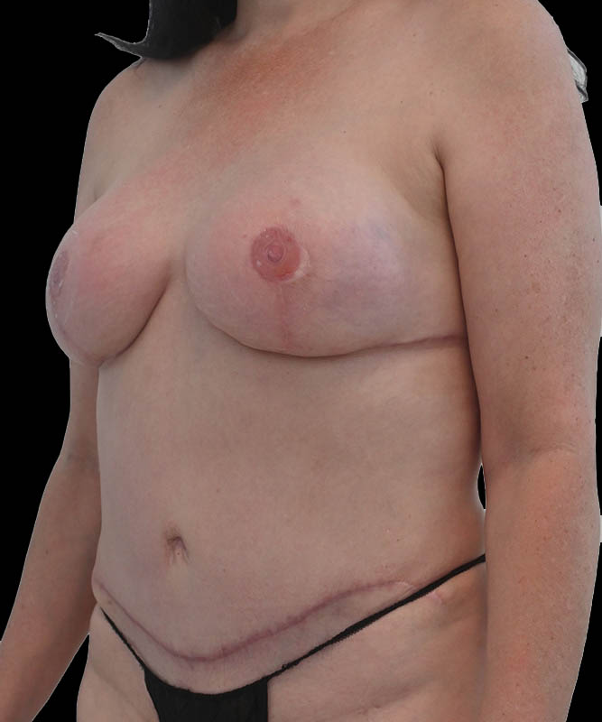 Hybrid Reconstruction Before & After Image
