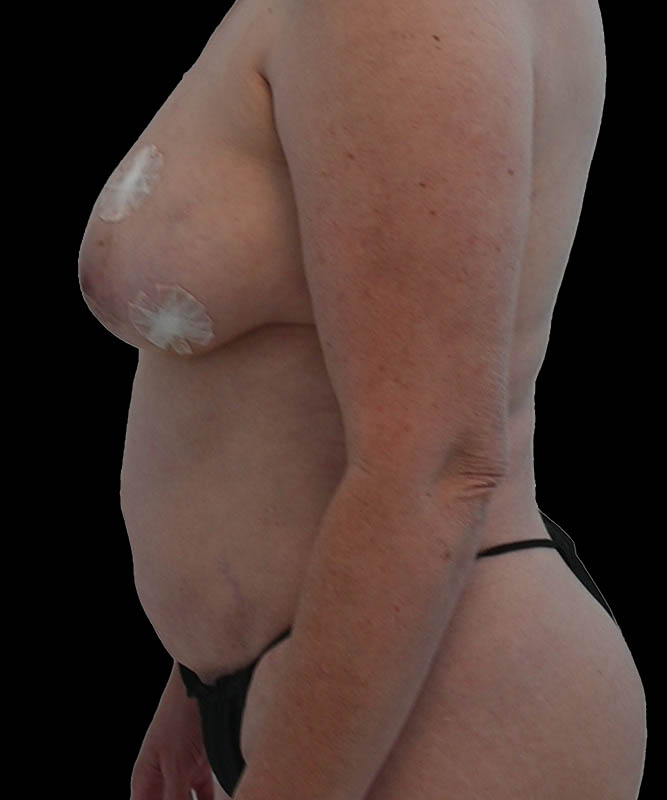 Hybrid Reconstruction Before & After Image