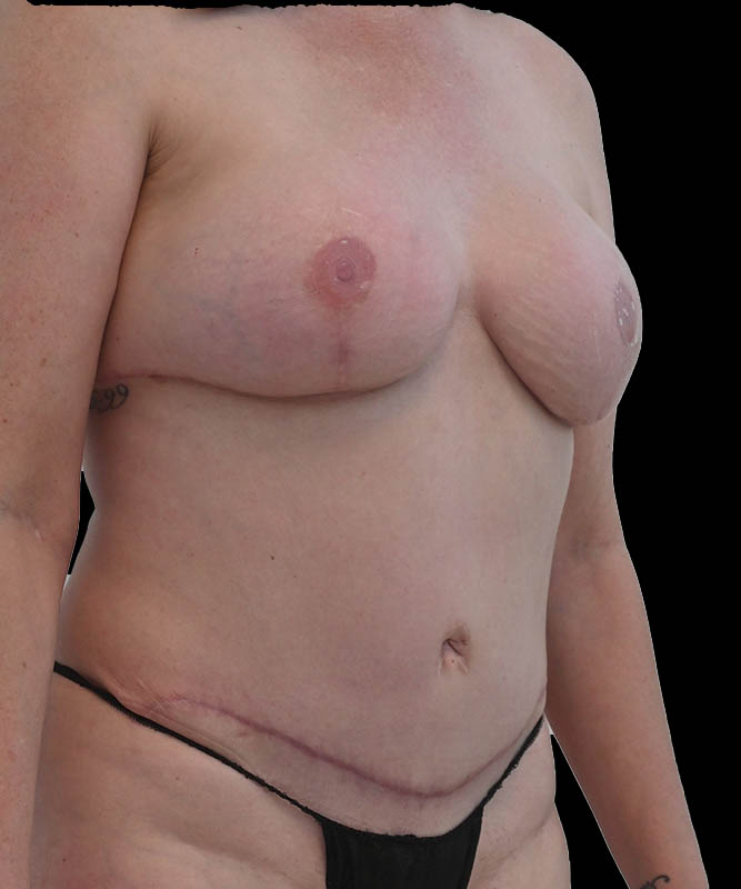 Hybrid Reconstruction Before & After Image