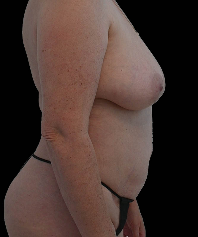 Hybrid Reconstruction Before & After Image