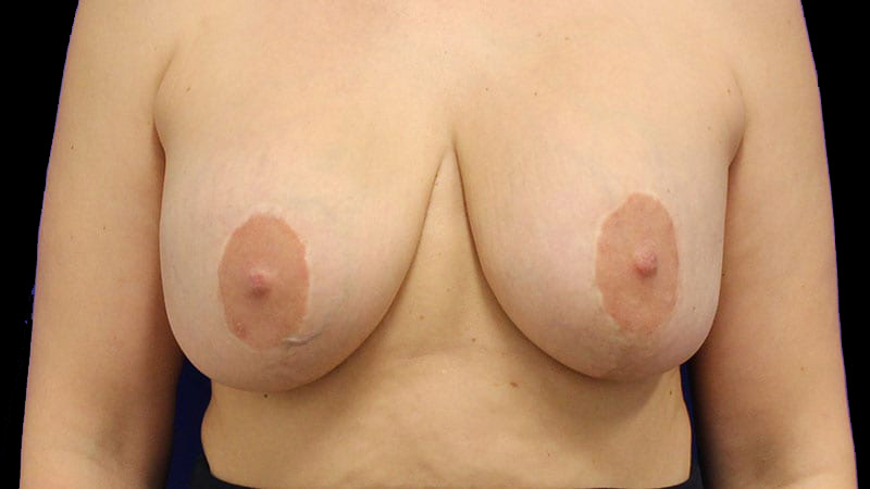 Implant Exchange/Mastopexy Before & After Image