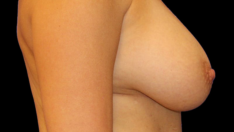 Implant Exchange/Mastopexy Before & After Image