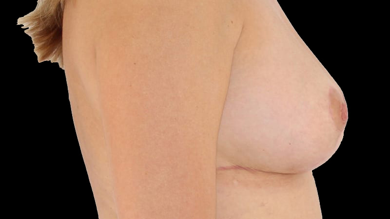 Implant Exchange/Mastopexy Before & After Image