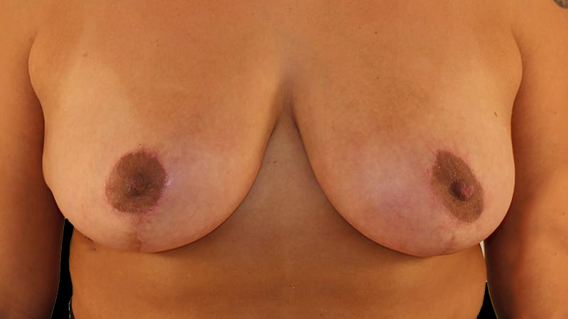 Implant Exchange/Mastopexy Before & After Image