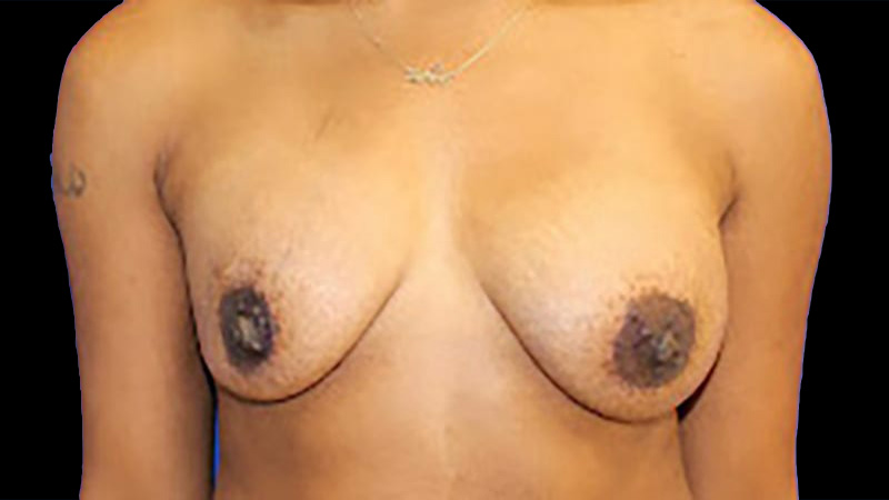 Implant Exchange/Mastopexy Before & After Image