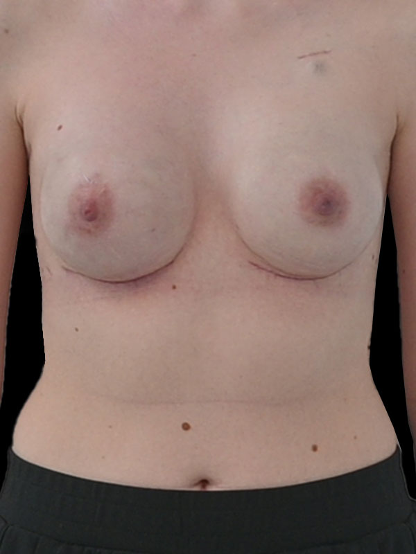 Implant Reconstruction Before & After Image