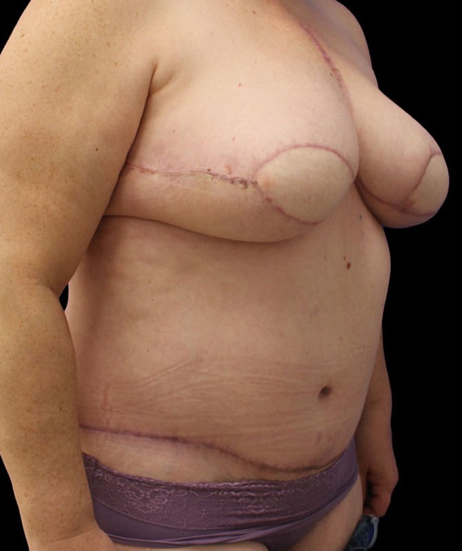 Implant to Flap Reconstruction Before & After Image