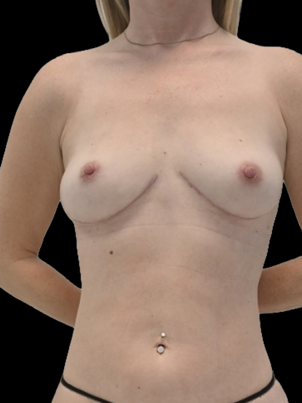 LAP Flap Surgery Before & After Image