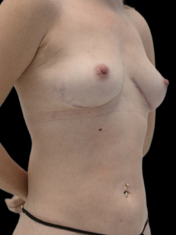 LAP Flap Surgery Before & After Image